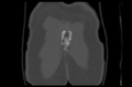 Aneurysmal bone cyst of ischium (Radiopaedia 25957-26094 Coronal bone window 46).png