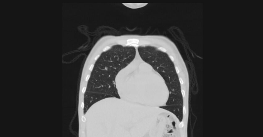 Angioinvasive aspergellosis (Radiopaedia 66995-76315 Coronal lung window 14).jpg