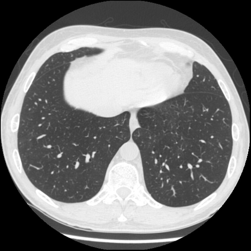 Angioinvasive aspergillosis (Radiopaedia 43957-47466 Axial lung window 54).jpg
