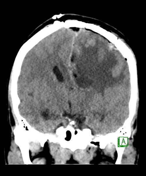 File:Angiomatous meningioma (Radiopaedia 79459-92578 Coronal non-contrast 19).jpg