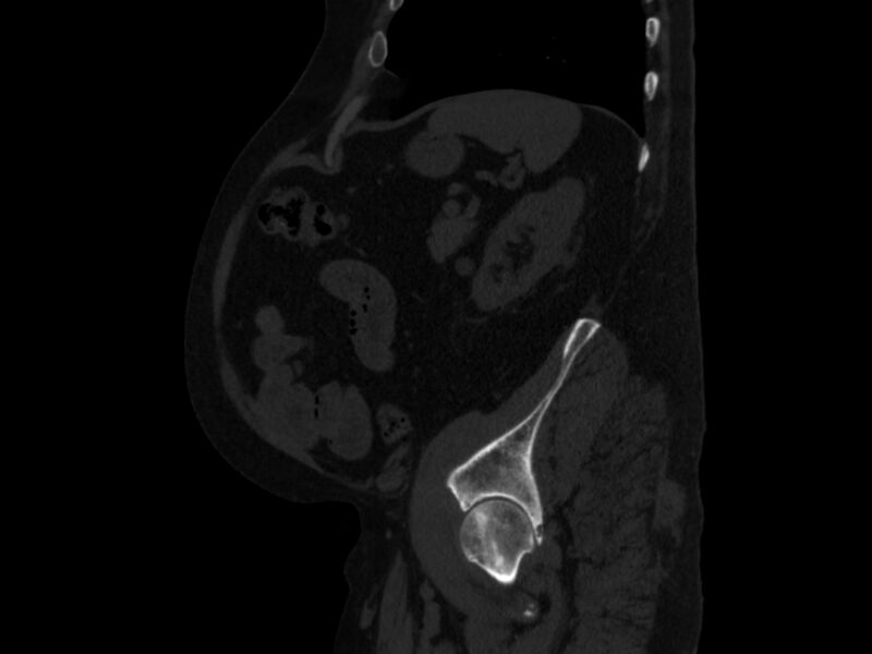 File:Ankylosing spondylitis (Radiopaedia 44609-48357 Sagittal bone window 88).jpg
