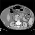 Annular pancreas and cirrhosis (Radiopaedia 24561-24843 A 10).jpg