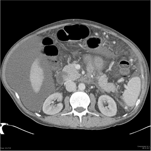 File:Annular pancreas and cirrhosis (Radiopaedia 24561-24843 A 10).jpg