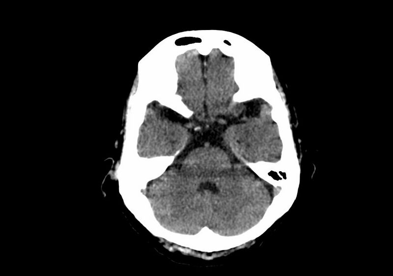 File:Anomalous intracranial venous drainage (Radiopaedia 28161-28418 Axial non-contrast 12).jpg