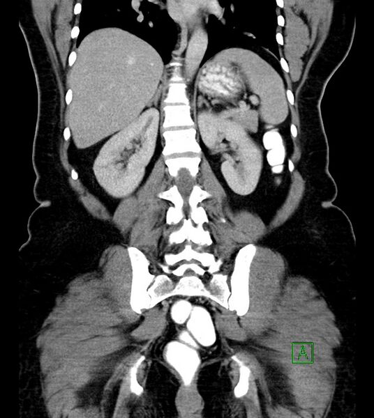File:Anterior abdominal wall CSF pseudocyst (CSFoma) (Radiopaedia 79453-92571 B 39).jpg