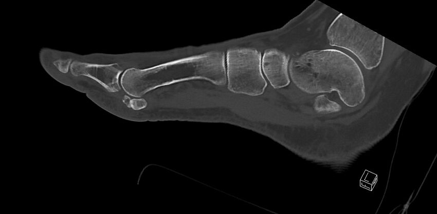 Anterior calcaneal process fracture (Radiopaedia 63353-71943 C 46).jpg