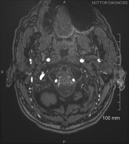 File:Anterior cerebral artery aneurysm (Radiopaedia 80683-94127 Axial MRA 2).jpg
