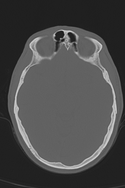 File:Anterior nasal spine fracture (Radiopaedia 46138-50494 Axial bone window 34).png