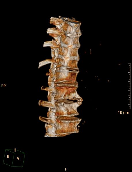 File:Anterior vertebral scalloping (abdominal aortic aneurysm) (Radiopaedia 66744-76067 A 6).jpg