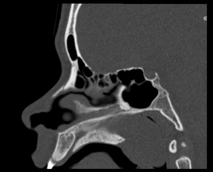File:Antrochoanal polyp (Radiopaedia 21894-21868 Sagittal bone window 21).jpg