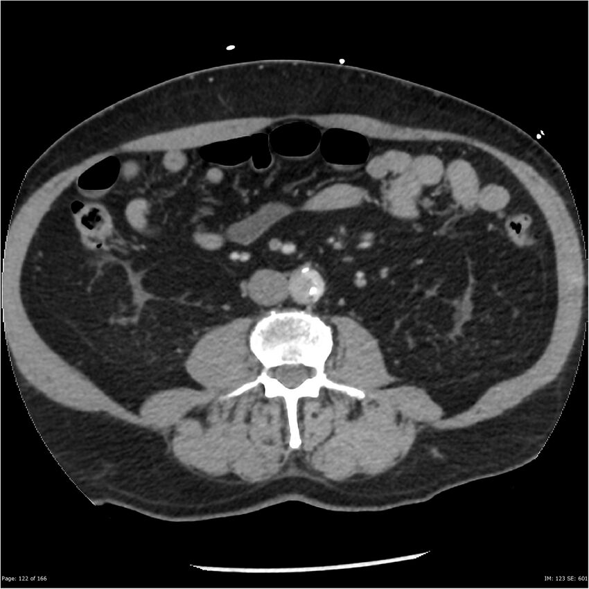 Aortic dissection- Stanford A (Radiopaedia 37759-39664 A 113).jpg