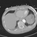 Aortic dissection - DeBakey type II (Radiopaedia 64302-73082 Axial lung window 52).png