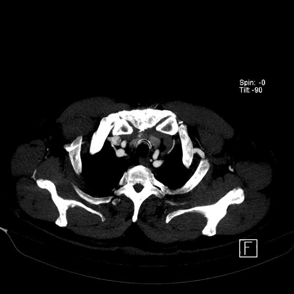 File:Aortic dissection - De Bakey type III - Stanford B (Radiopaedia 21903-21882 B 9).jpg