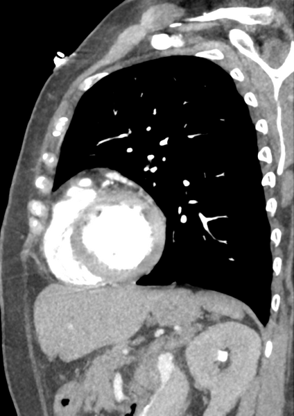 File:Aortic dissection - Stanford type B (Radiopaedia 50171-55512 C 12).png