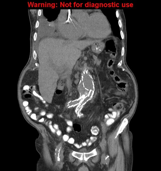 File:Aortic graft infection (Radiopaedia 44979-48907 non-contrast 21).jpg