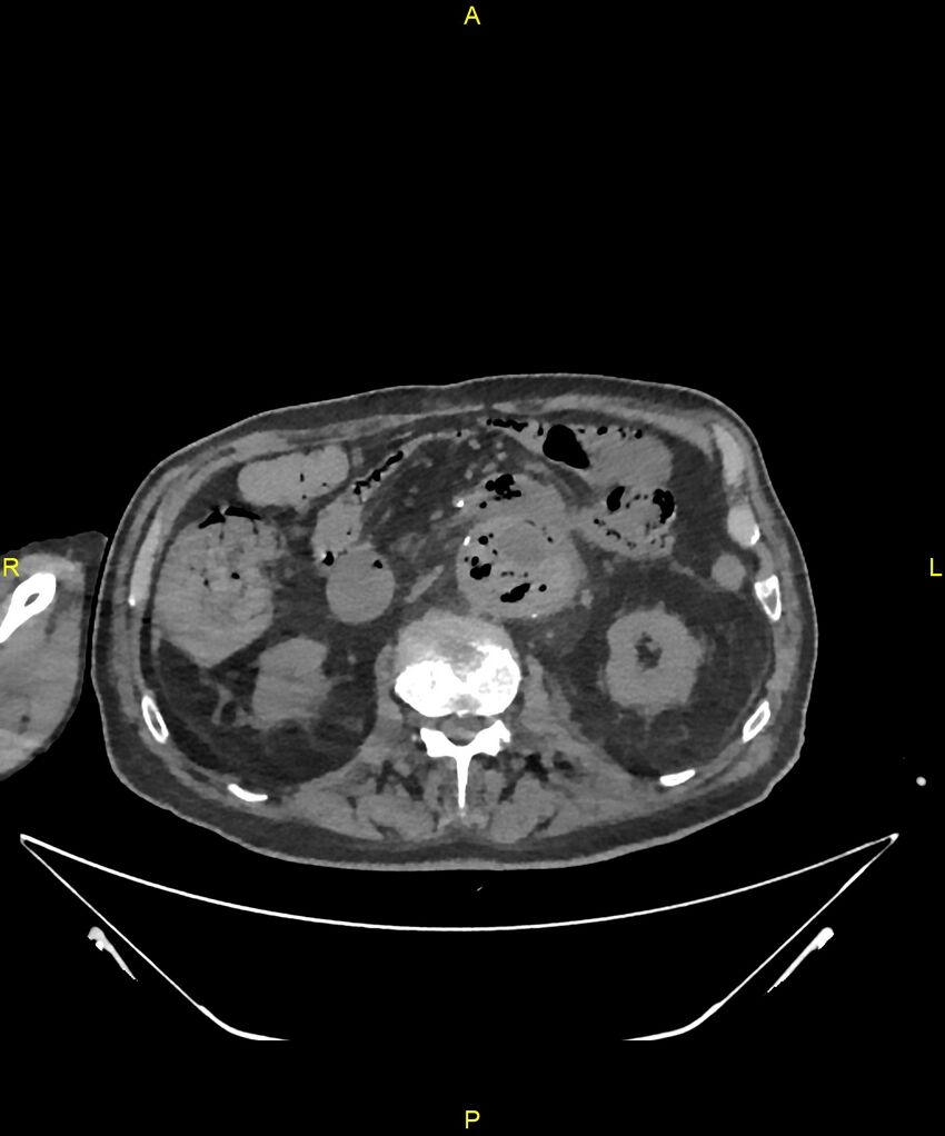 Aortoenteric fistula (Radiopaedia 84308-99603 Axial non-contrast 148).jpg