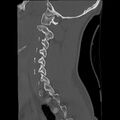 Apical pneumothorax on cervical spine CT (Radiopaedia 45343-49368 Sagittal bone window 25).jpg
