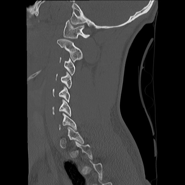 File:Apical pneumothorax on cervical spine CT (Radiopaedia 45343-49368 Sagittal bone window 25).jpg