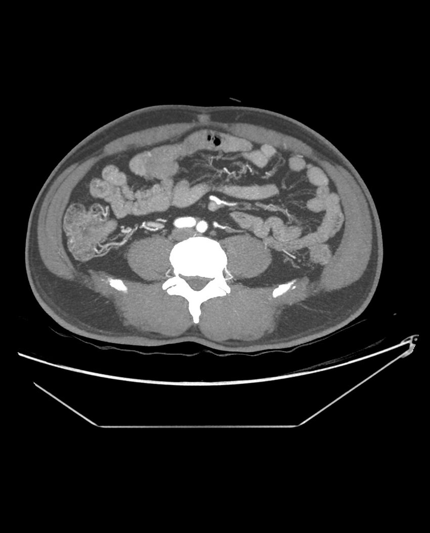 Aplastic posterior tibial arteries (Radiopaedia 84021-99249 A 69).jpg