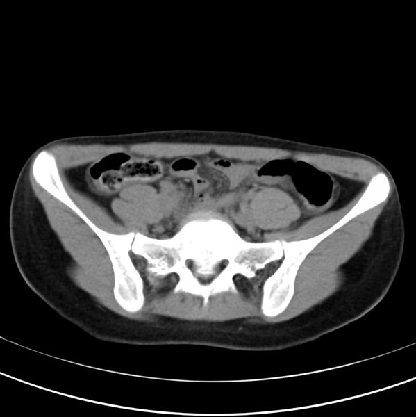 File:Appendicitis and incidental bicornuate uterus (Radiopaedia 22833-22853 Axial non-contrast 33).jpg