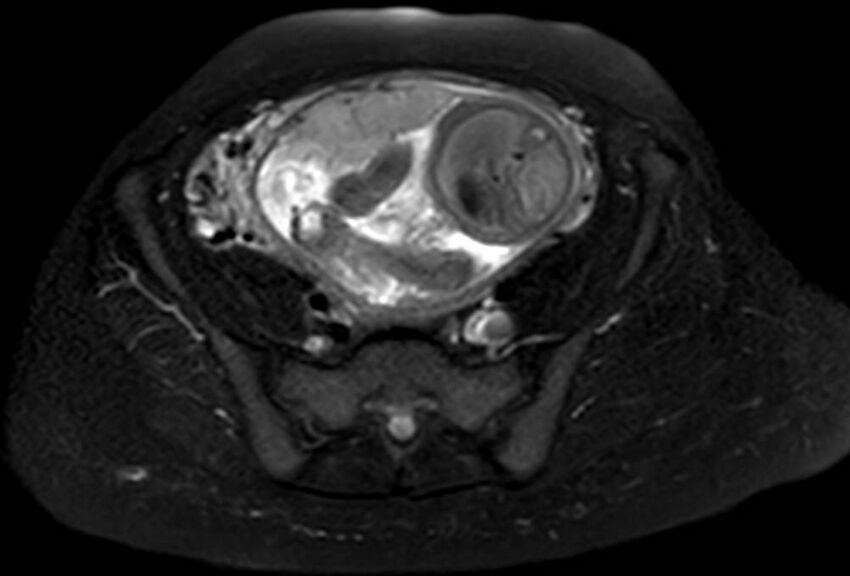 Appendicitis in gravida (MRI) (Radiopaedia 89433-106395 Axial T2 SPAIR 56).jpg