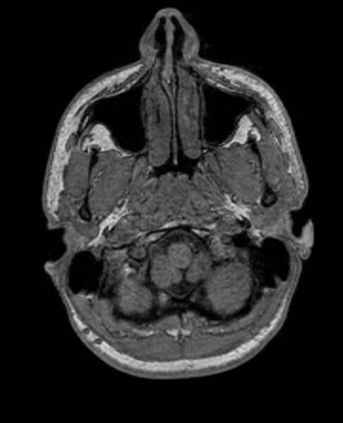 File:Arachnoid cyst- extremely large (Radiopaedia 68741-78451 Axial T1 10).jpg