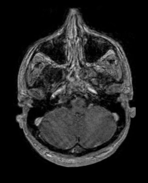 File:Arachnoid cyst- extremely large (Radiopaedia 68741-78451 Axial T1 C+ 19).jpg