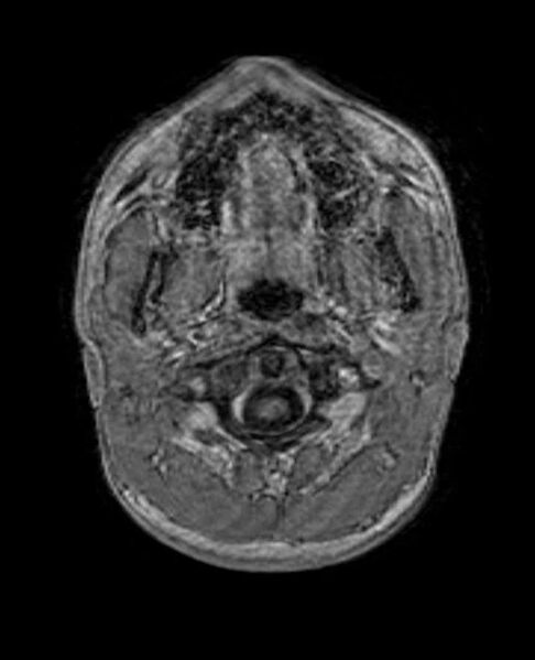File:Arachnoid cyst- extremely large (Radiopaedia 68741-78451 Axial T1 C+ 3).jpg
