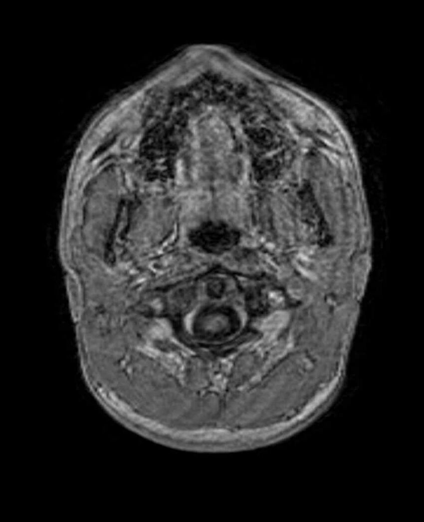 Arachnoid cyst- extremely large (Radiopaedia 68741-78451 Axial T1 C+ 3).jpg