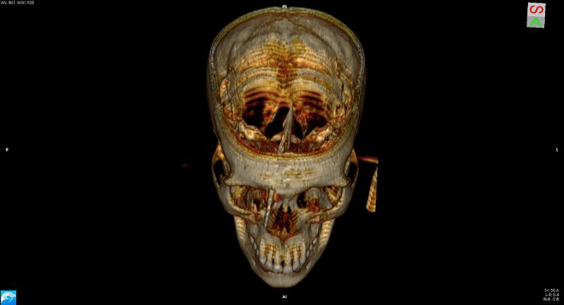 File:Arrow injury to the brain (Radiopaedia 72101-82607 3D bone 13).jpg