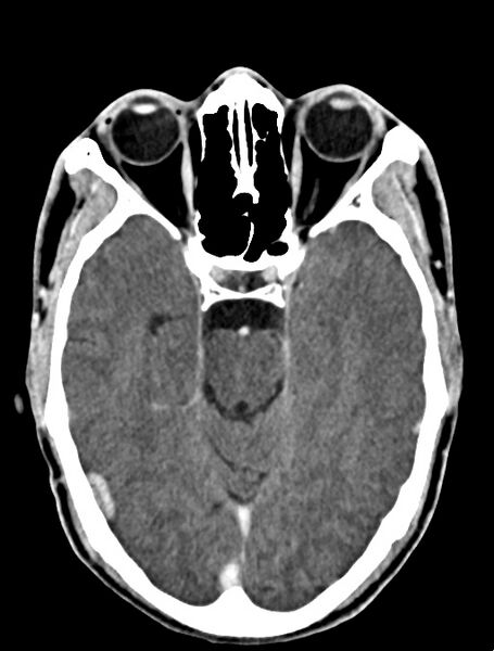 File:Arrow injury to the face (Radiopaedia 73267-84011 Axial C+ delayed 46).jpg
