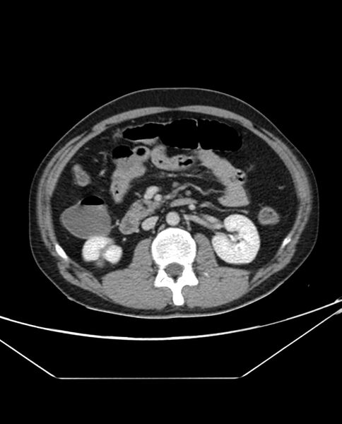 File:Arterial occlusive mesenteric ischemia (Radiopaedia 84641-100054 A 51).jpg