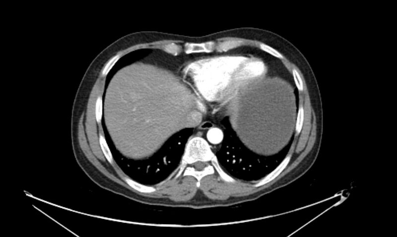 File:Arterial occlusive mesenteric ischemia (Radiopaedia 84641-100060 A 17).jpg