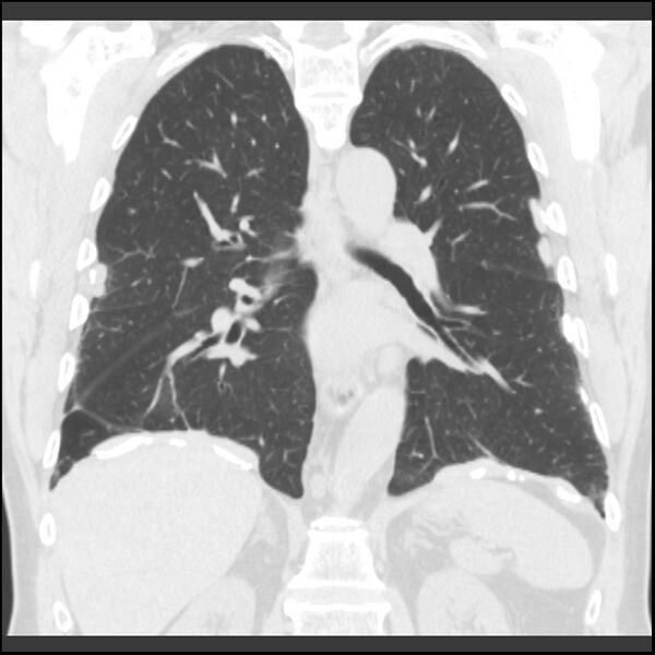 File:Asbestos-related pleural plaques (Radiopaedia 39069-41255 Coronal lung window 35).jpg