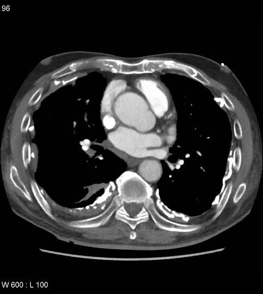 File:Asbestos related lung and pleural disease (Radiopaedia 14377-14301 D 32).jpg