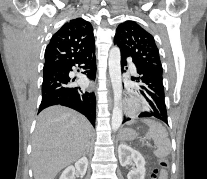 File:Ascending aortic aneurysm (Radiopaedia 86279-102297 B 44).jpg