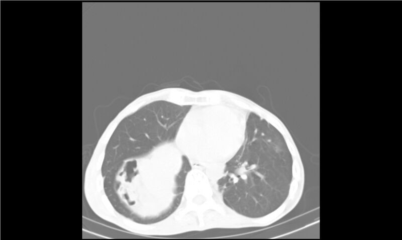 File:Aspergilloma (Radiopaedia 20788-20701 Axial lung window 24).jpg