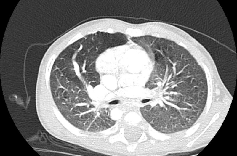 File:Asplenia syndrome (Radiopaedia 73083-83792 Axial lung window 29).jpg