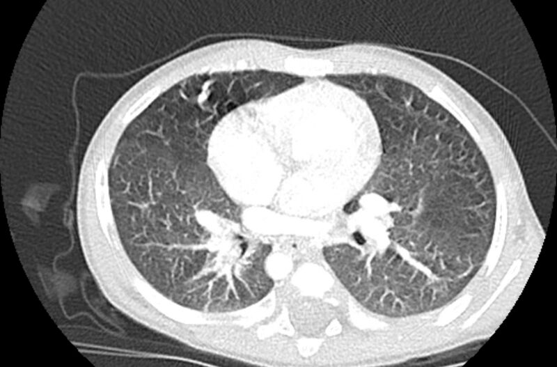 File:Asplenia syndrome (Radiopaedia 73083-83792 Axial lung window 35).jpg