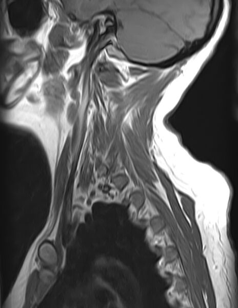 File:Astrocytoma - spinal cord (Radiopaedia 69769-79758 Sagittal T1 12).jpg