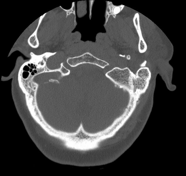 File:Atlanto-occipital assimilation with basilar invagination (Radiopaedia 70122-80188 Axial bone window 4).jpg