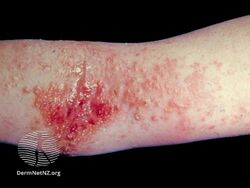 Eczema - widespread vesicles