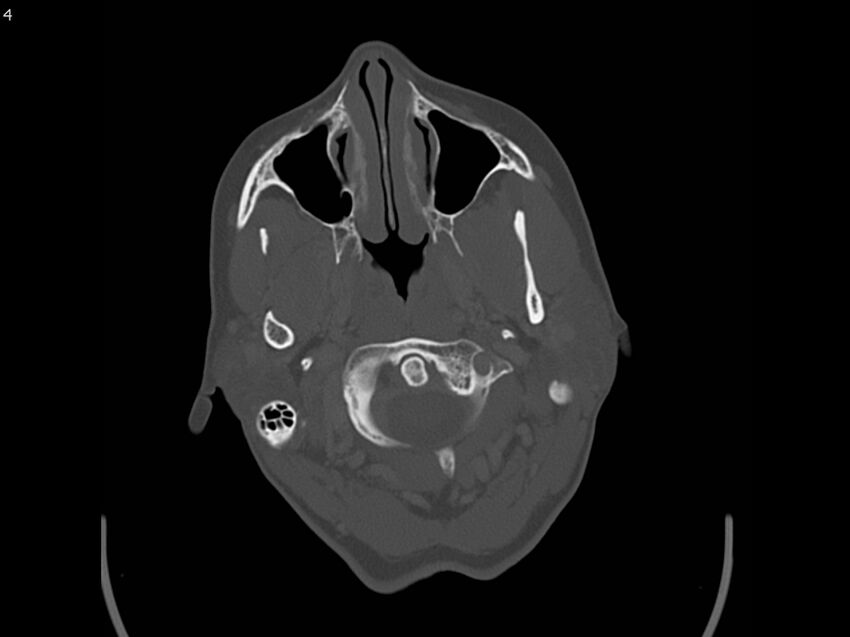 Atypical meningioma - intraosseous (Radiopaedia 64915-73867 Axial C+ bone window 4).jpg
