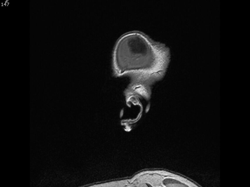Atypical meningioma - intraosseous (Radiopaedia 64915-74572 Sagittal T1 147).jpg