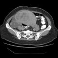 Atypical retroperitoneal lymphocoeles with large leiomyoma of uterus (Radiopaedia 32084-33024 A 27).jpg
