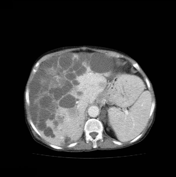 File:Autosomal dominant polycystic kidney disease (Radiopaedia 16777-16490 A 14).jpg