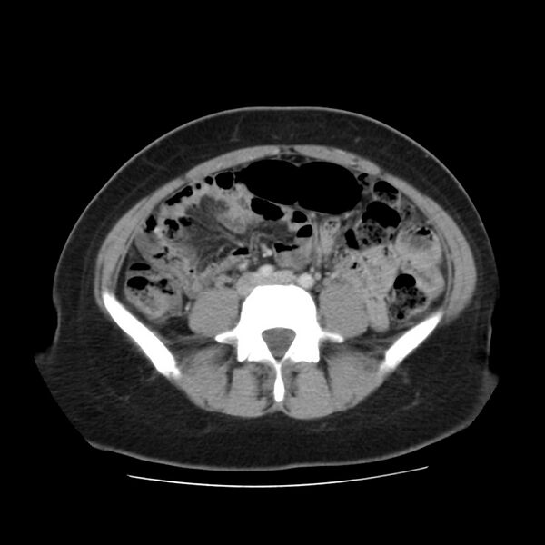 File:Autosomal dominant polycystic kidney disease (Radiopaedia 23061-23093 C 44).jpg