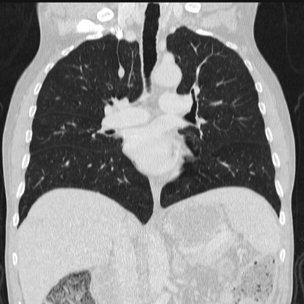 File:Azygos lobe (Radiopaedia 38259-40275 Coronal lung window 42).jpg