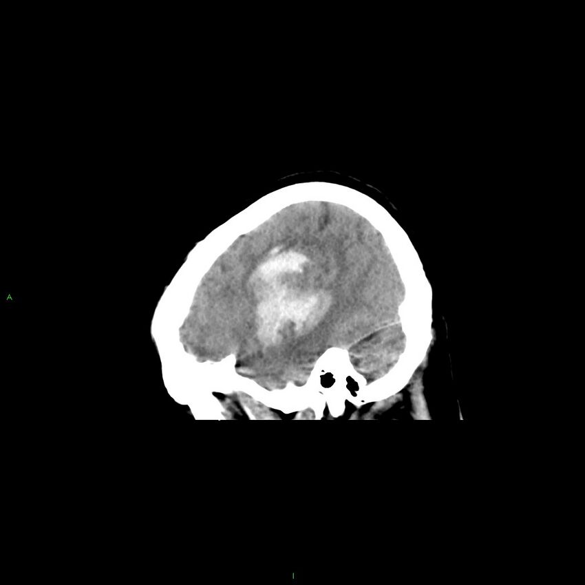 Basal ganglia hemorrhage (Radiopaedia 58349-65472 C 42).jpg