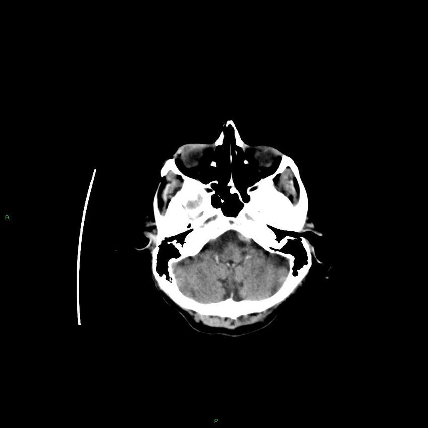 Basal ganglia hemorrhage (Radiopaedia 58350-65473 Axial non-contrast 37).jpg